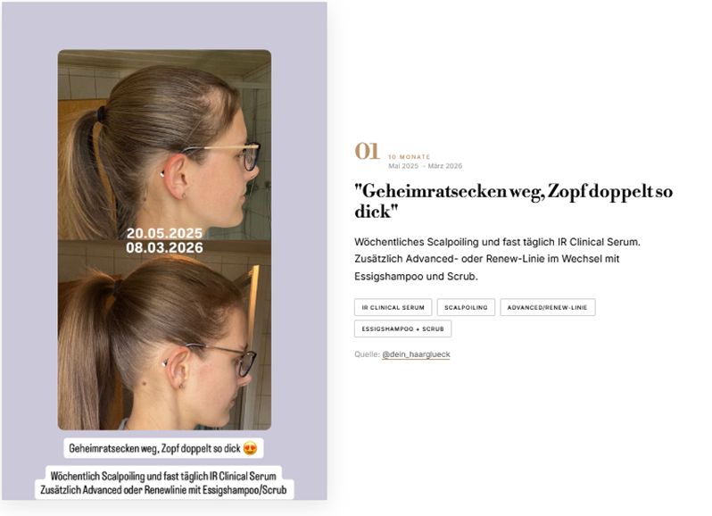 Vorher/Nachher Haarausfall – Geheimratsecken nach MONAT IR Clinical