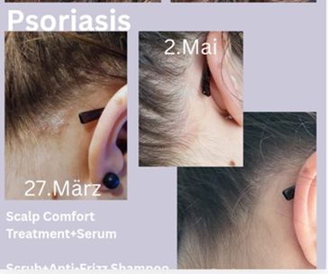 Psoriasis Kopfhaut vorher/nachher – MONAT Scalp Comfort